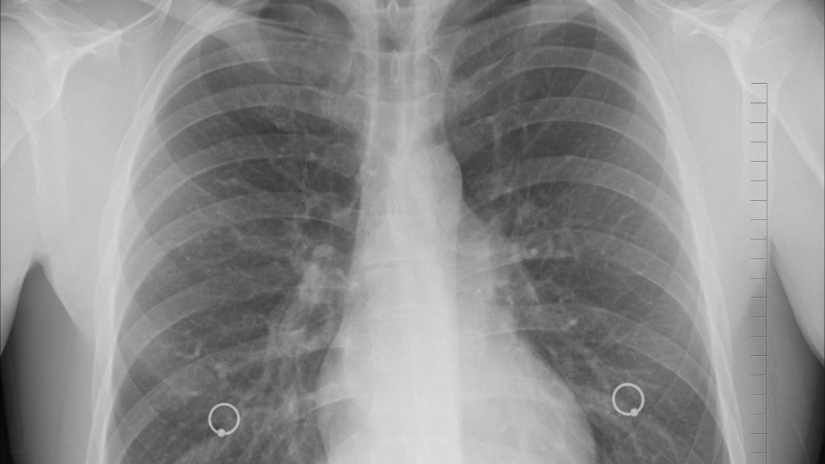 cockroach-plungs-xray-canva